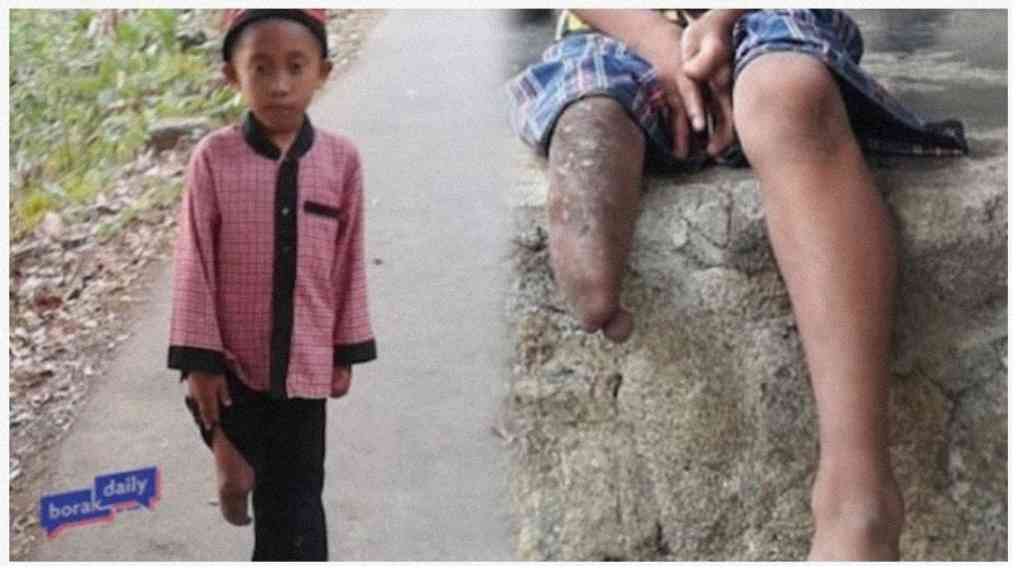 Lahir Hanya Memiliki Satu Kaki, Anak Yatim Ini Melompat-lompat Saat Pergi ke Sekolah dan Ingin Jadi Hafidz